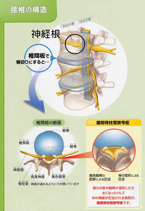 坐骨神経痛八王子・狭窄症