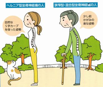 坐骨神経痛八王子・症状1