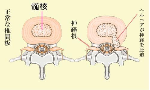坐骨神経痛八王子・椎間板ヘルニア