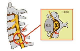 坐骨神経痛八王子・変形性腰痛症