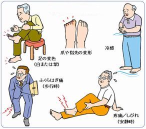 坐骨神経痛八王子・閉塞性動脈硬化症