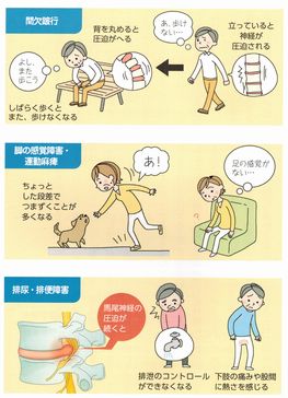 坐骨神経痛八王子・間欠跛行